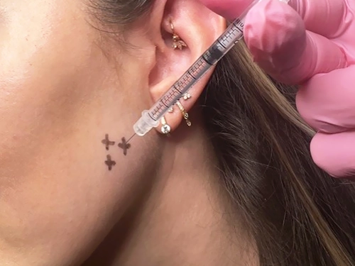 masseter botox 296