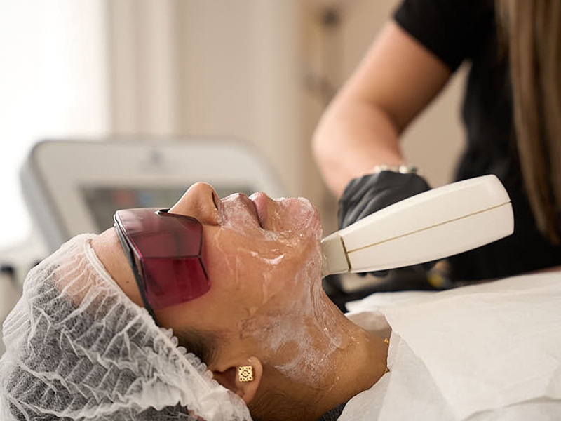 rosacea treatment1
