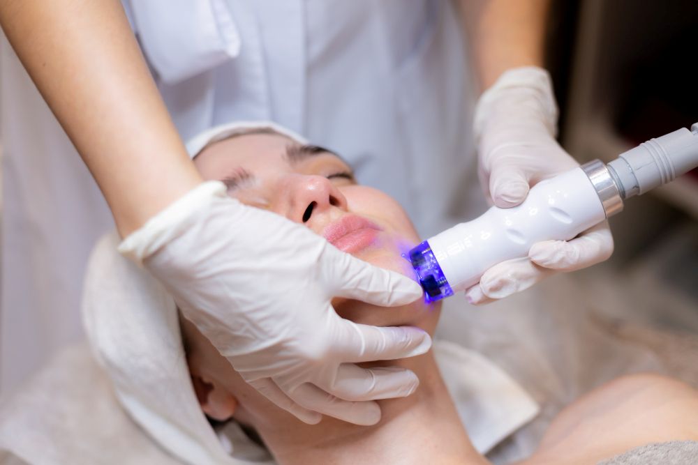 candela vbeam laser
